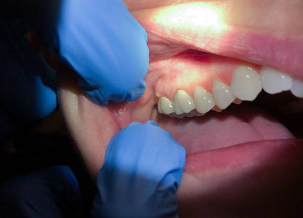 Best Emergency Tooth Extraction in Waxahachie, TX